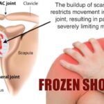 Frozen Shoulder: Symptoms, Treatment  and Prevention