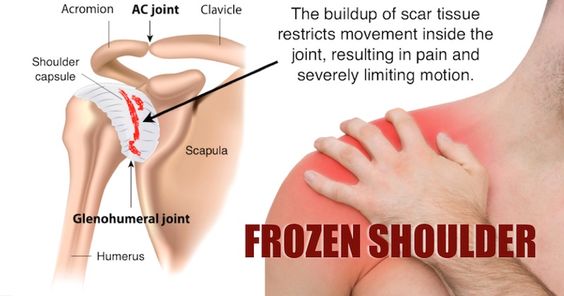 Frozen Shoulder: Symptoms, Treatment  and Prevention