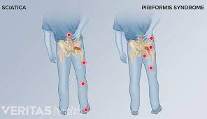 Piriformis Syndrome: